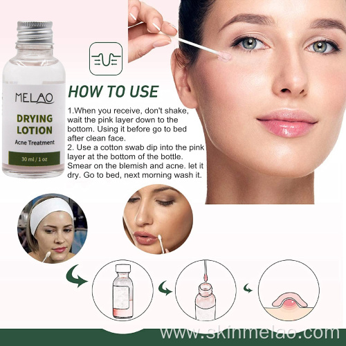 Drying Lotion Anti Acne Spot Treatment Serum